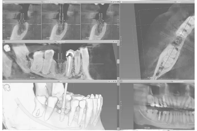 Cursus Implantologie