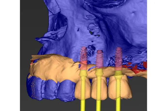 Cursus Implantologie