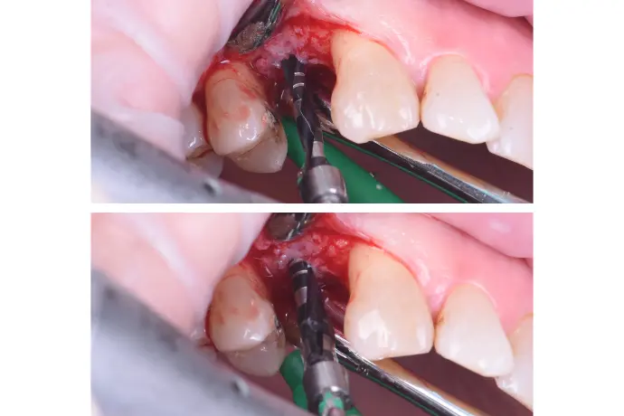 Cursus Implantologie