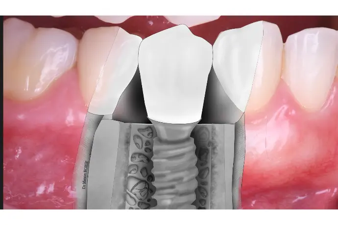 Cursus Implantologie