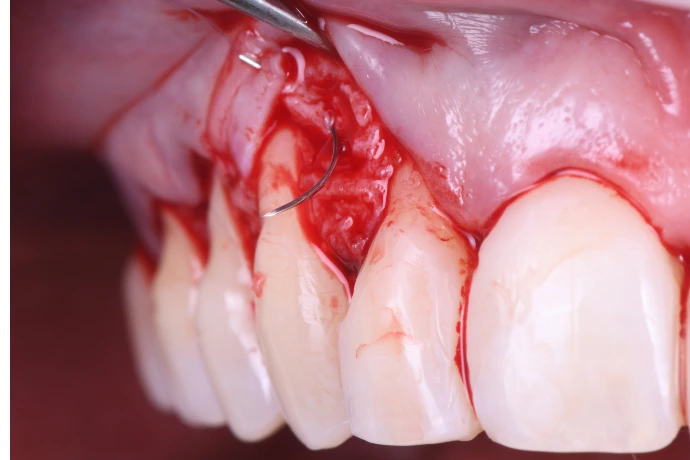 Chirurgie plastique péri-implantaire &amp; paro