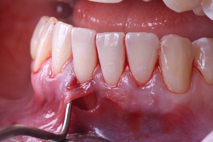 Chirurgie plastique péri-implantaire &amp; paro