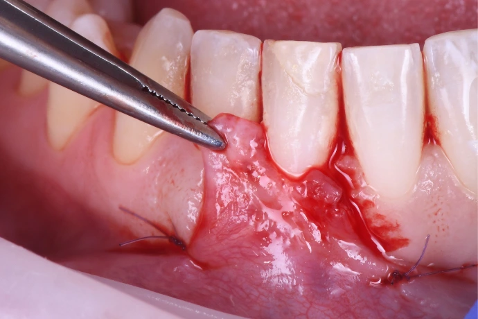 Chirurgie plastique péri-implantaire &amp; paro