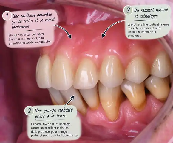 Prothèse amovible clipsée sur barre implantaire