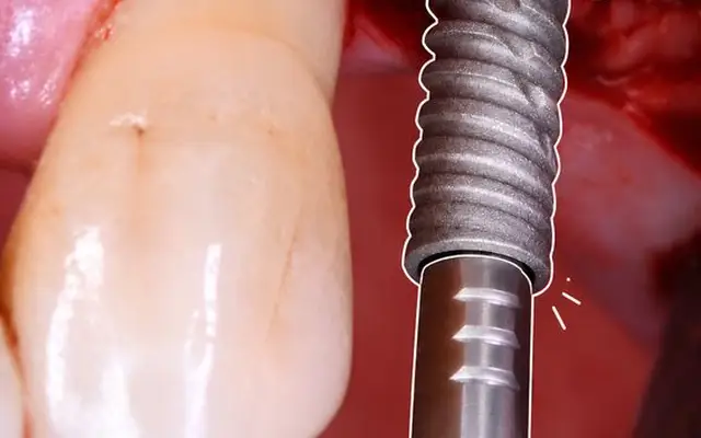 Implantologie : dent remplacée par un implant