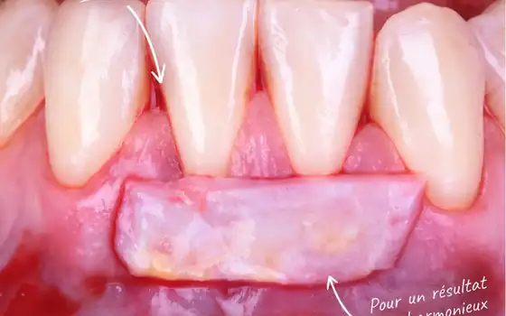 Greffe gingivale